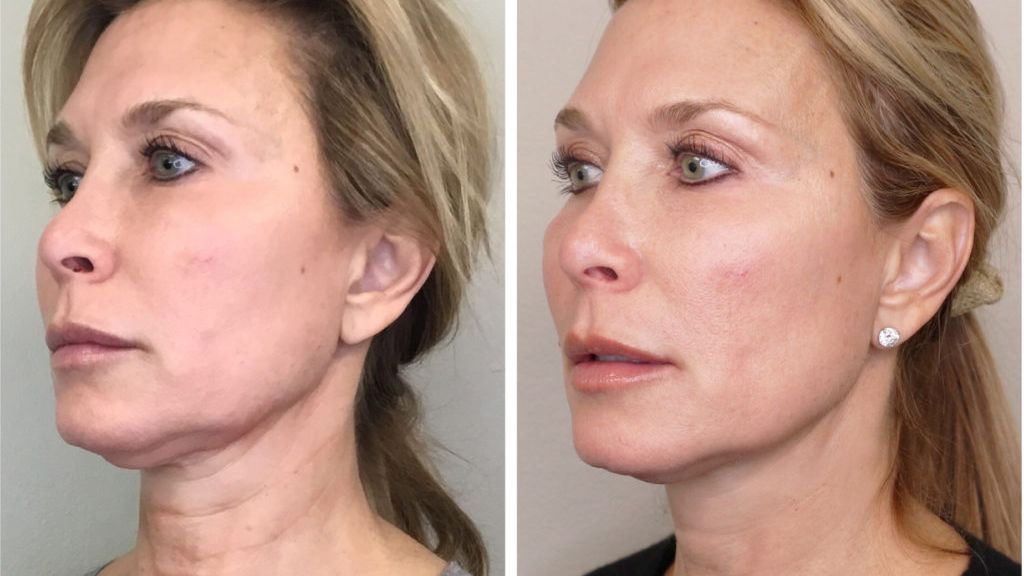 A-before-and-after-photo-showing-a-woman's-jawline-and-neck-improvement-from-a-skin-tightening-treatment
