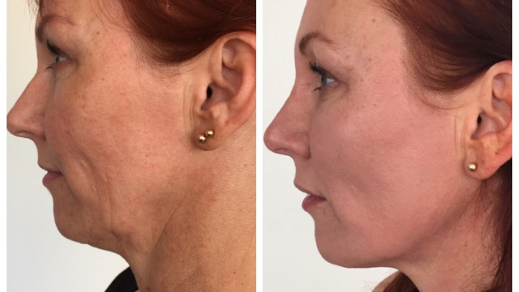 A-comparison-photo-showing-the-before-and-after-results-of-a-skin-tightening-treatment-on-a-woman's-jawline-and-neck-area-with-visible-improvement