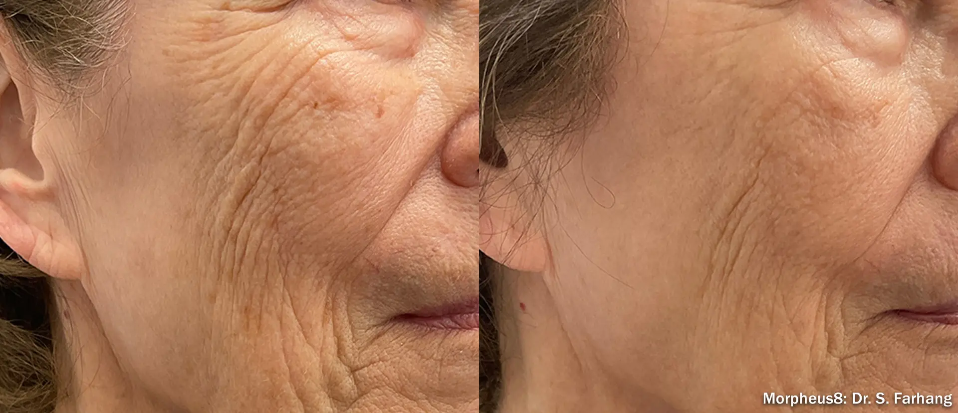 Before-and-after-results-of-skin-tightening-treatment-showing-reduction-of-wrinkles-and-skin-smoothness.
