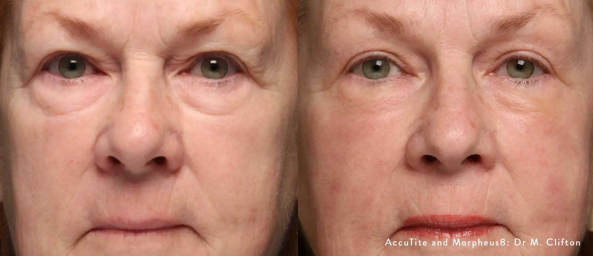 Before-and-after-results-of-AccuTite-and-Morpheus8-treatment-showing-improvement-in-skin-tightening-and-reduction-of-wrinkles.