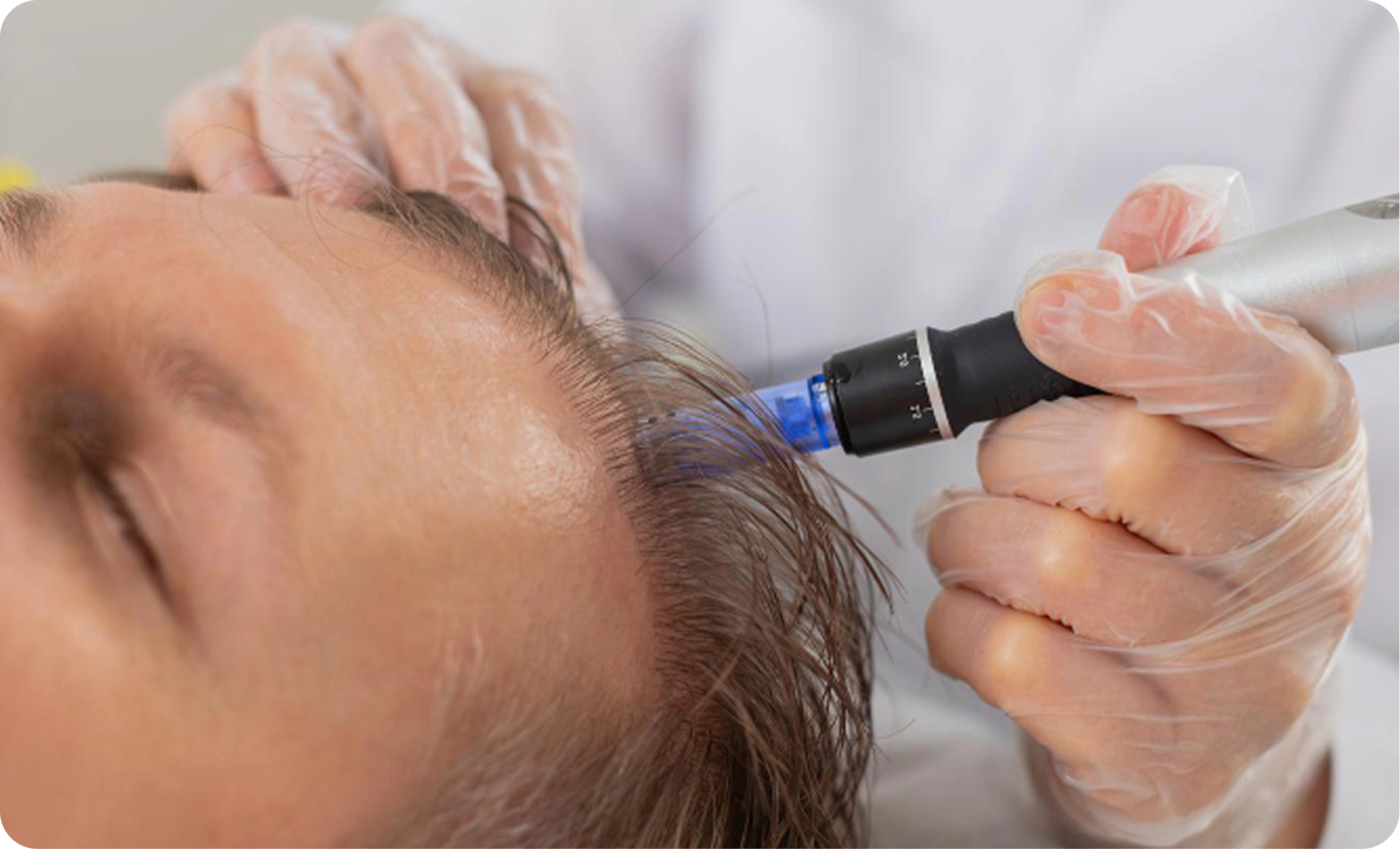 Microneedling for hair loss