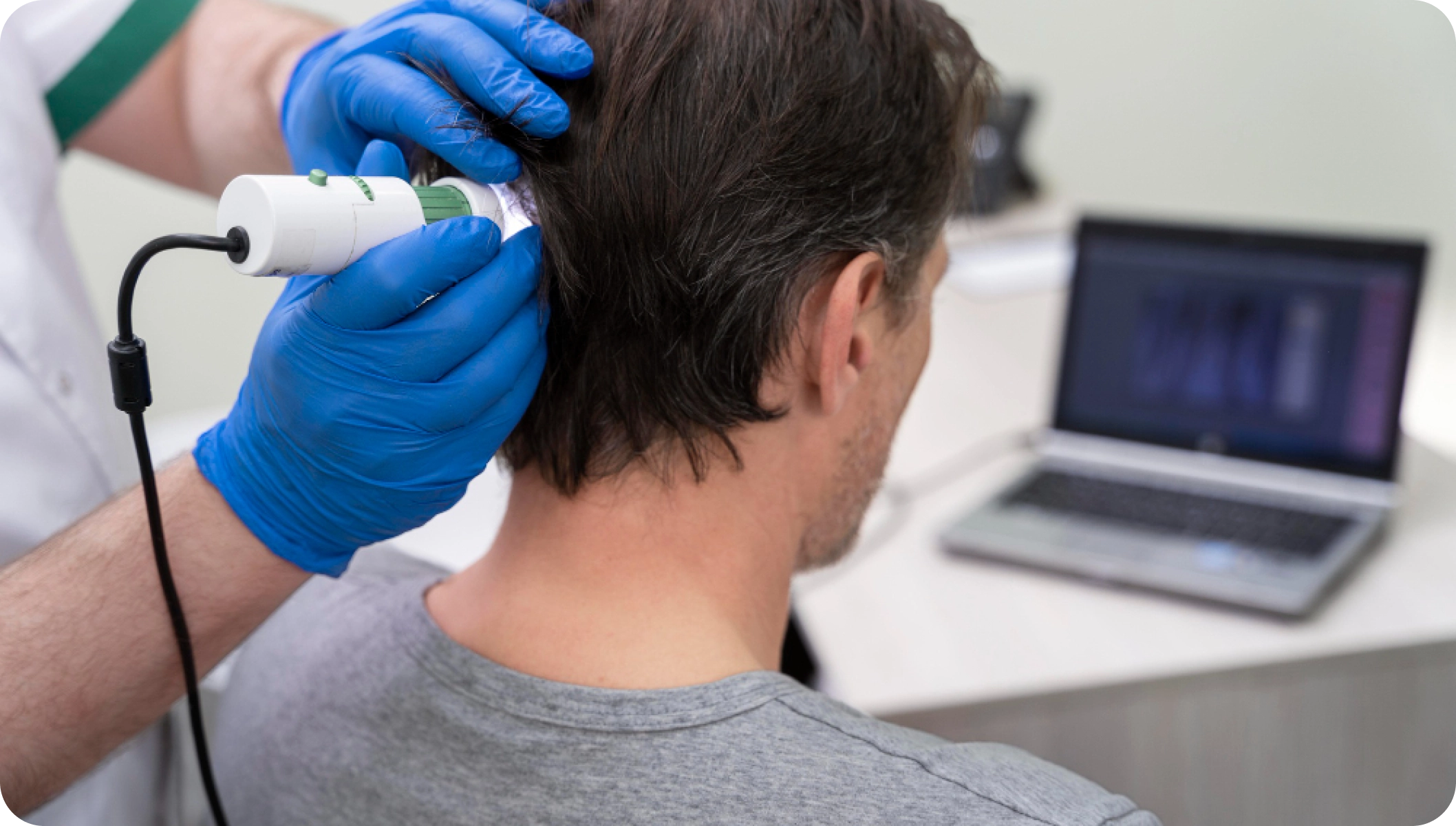 Microneedling for hair loss